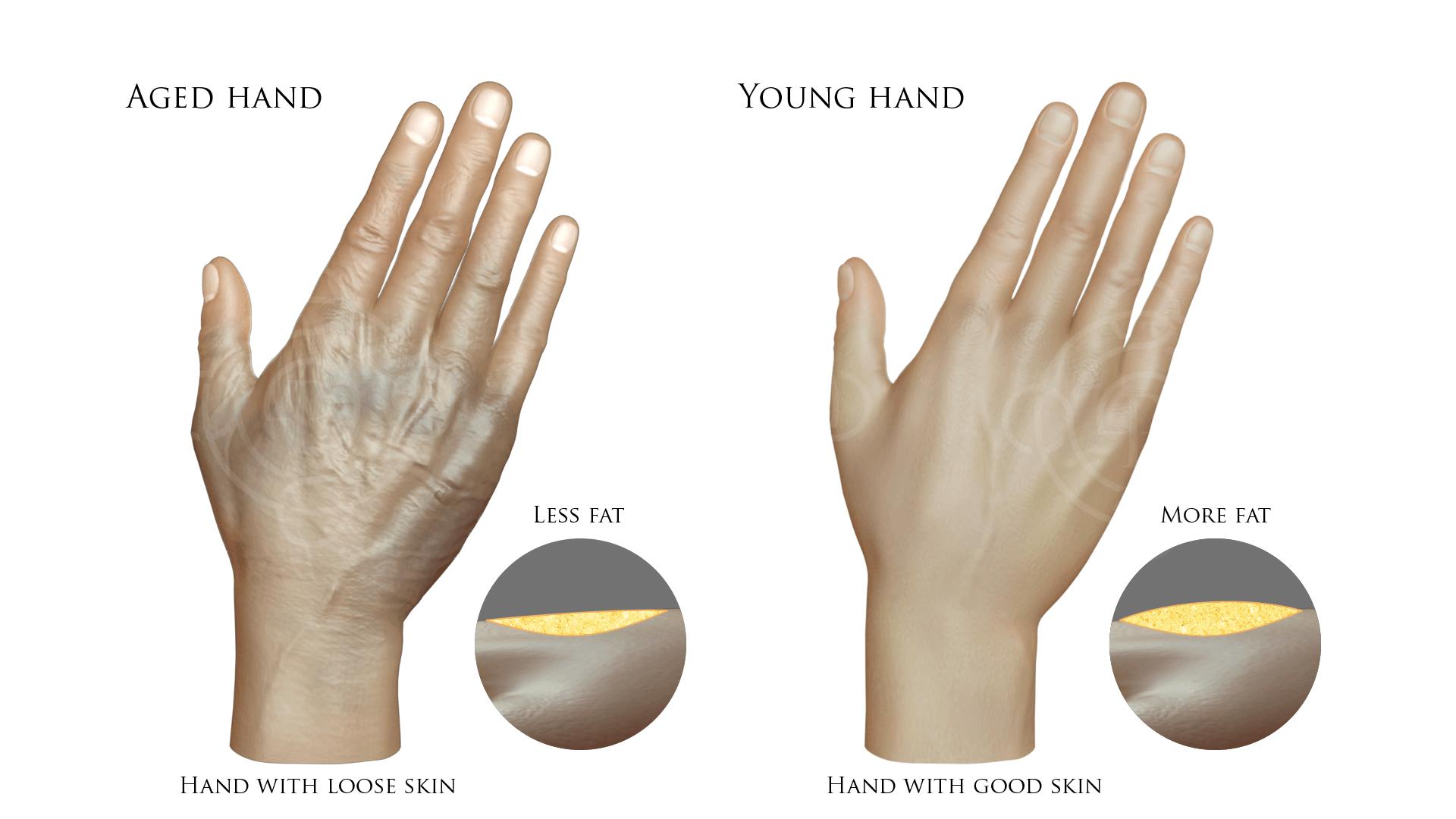 West Palm Beach Hand Rejuvenation Wellington Hand Cosmetic Surgery