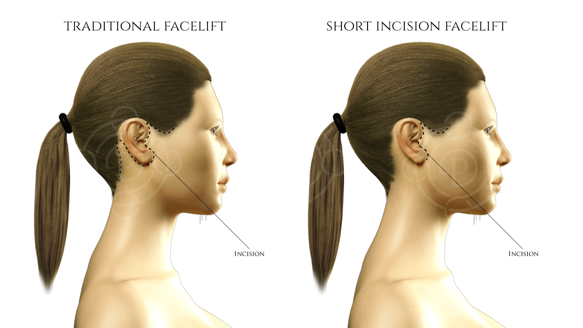 West Palm Beach Facelift Surgery Wellington Rhytidectomy Plastic Surgeon