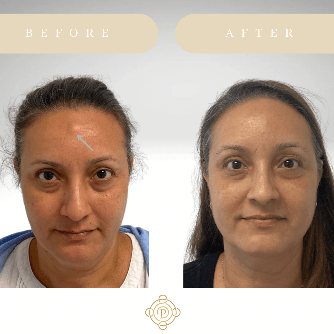 West Palm Beach Osteoma Removal Wellington Osteoma Treatment