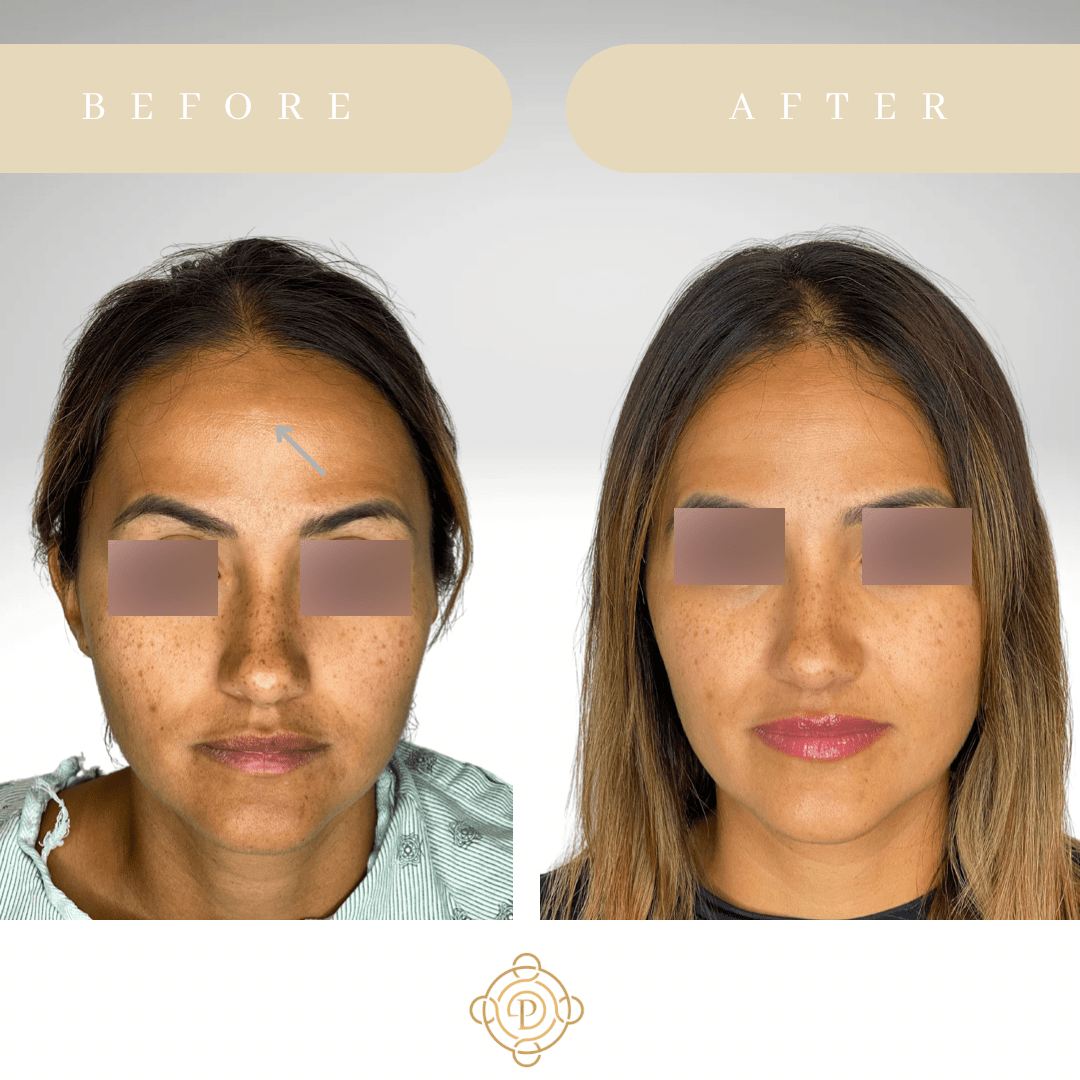 West Palm Beach Osteoma Removal Wellington Osteoma Treatment