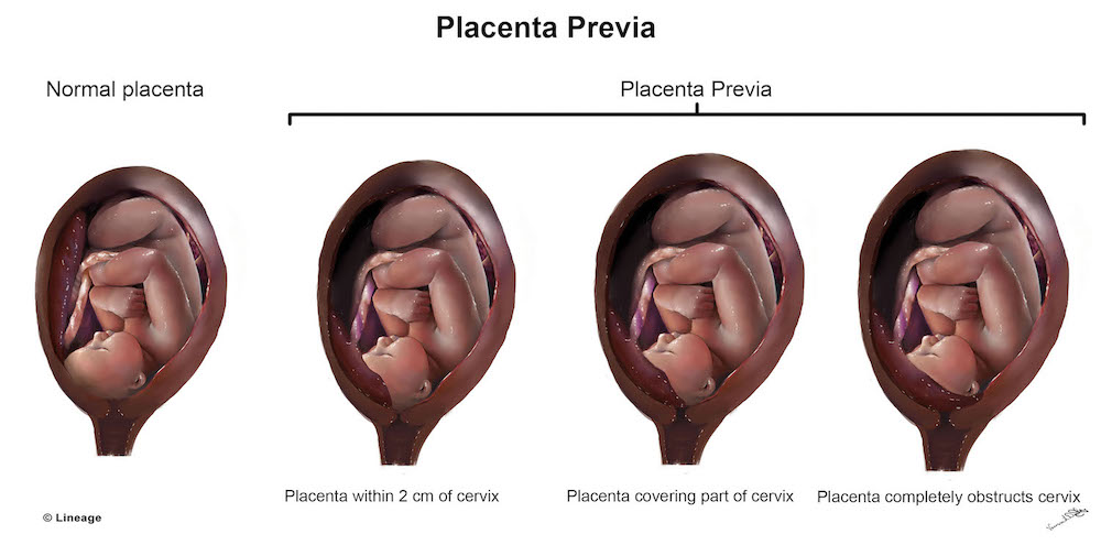 Complications And Risks of Placenta Previa During Pregnancy