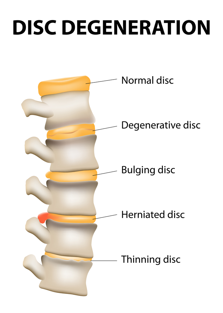 Facet Joint Replacement for the Treatment of Degenerative Spine