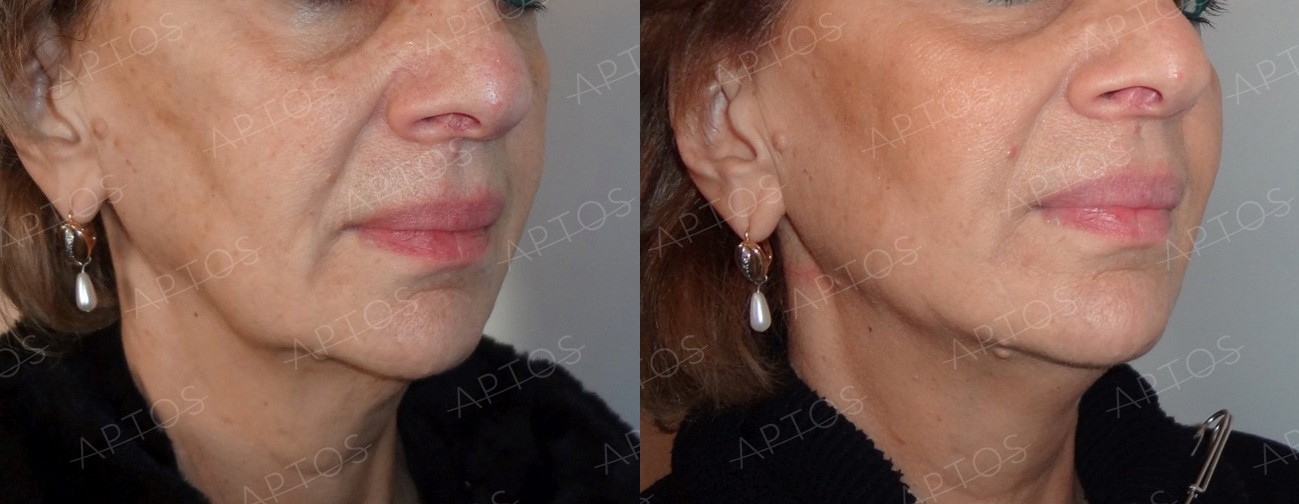 Mesothreads minilifting Premier Clinic