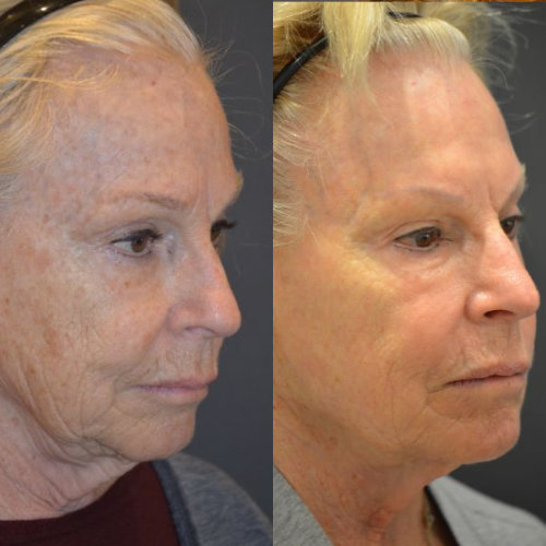 NYC Face Laser Skin Resurfacing Manhattan Laser Skin Rejuvenation UES