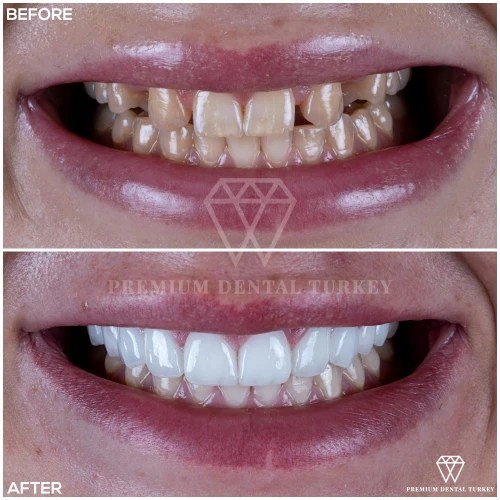 Dental Crowns Turkey Dental Crown Prices in Turkey