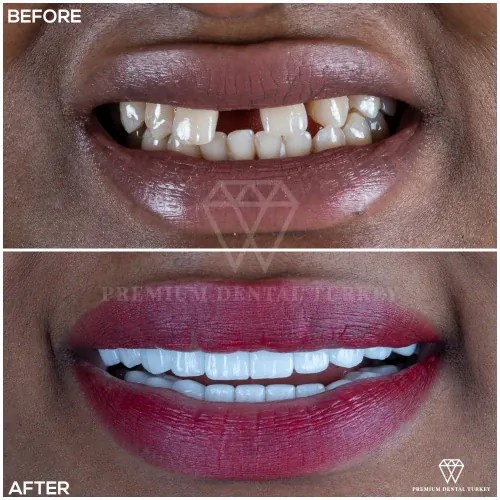 Dental Crowns Turkey Dental Crown Prices in Turkey