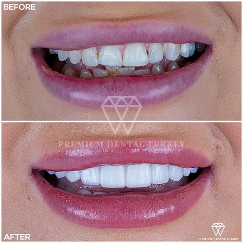 Turkey Teeth Everything you need to know before getting your teeth