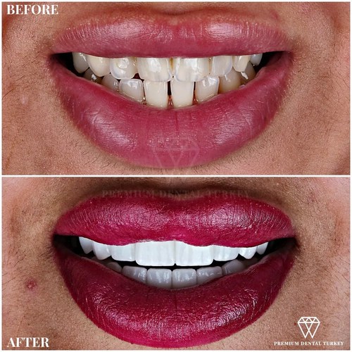 Turkey Teeth Everything you need to know before getting your teeth