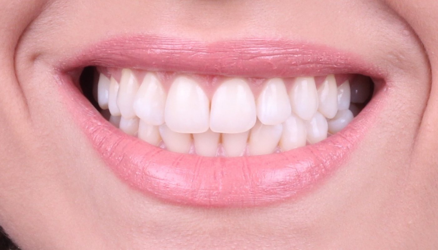 How much is a full set of veneers in Turkey?