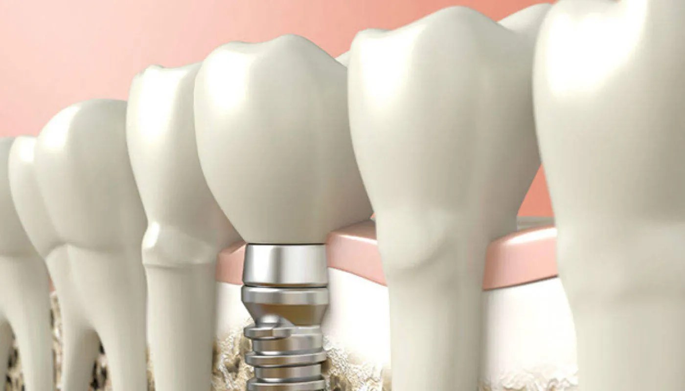 Dental Implants in Turkey Prices, Advantages. Full mouth and same day
