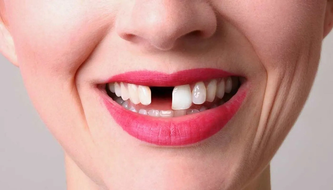 How to Fix Gaps Between Teeth Close the Gaps Between Teeth