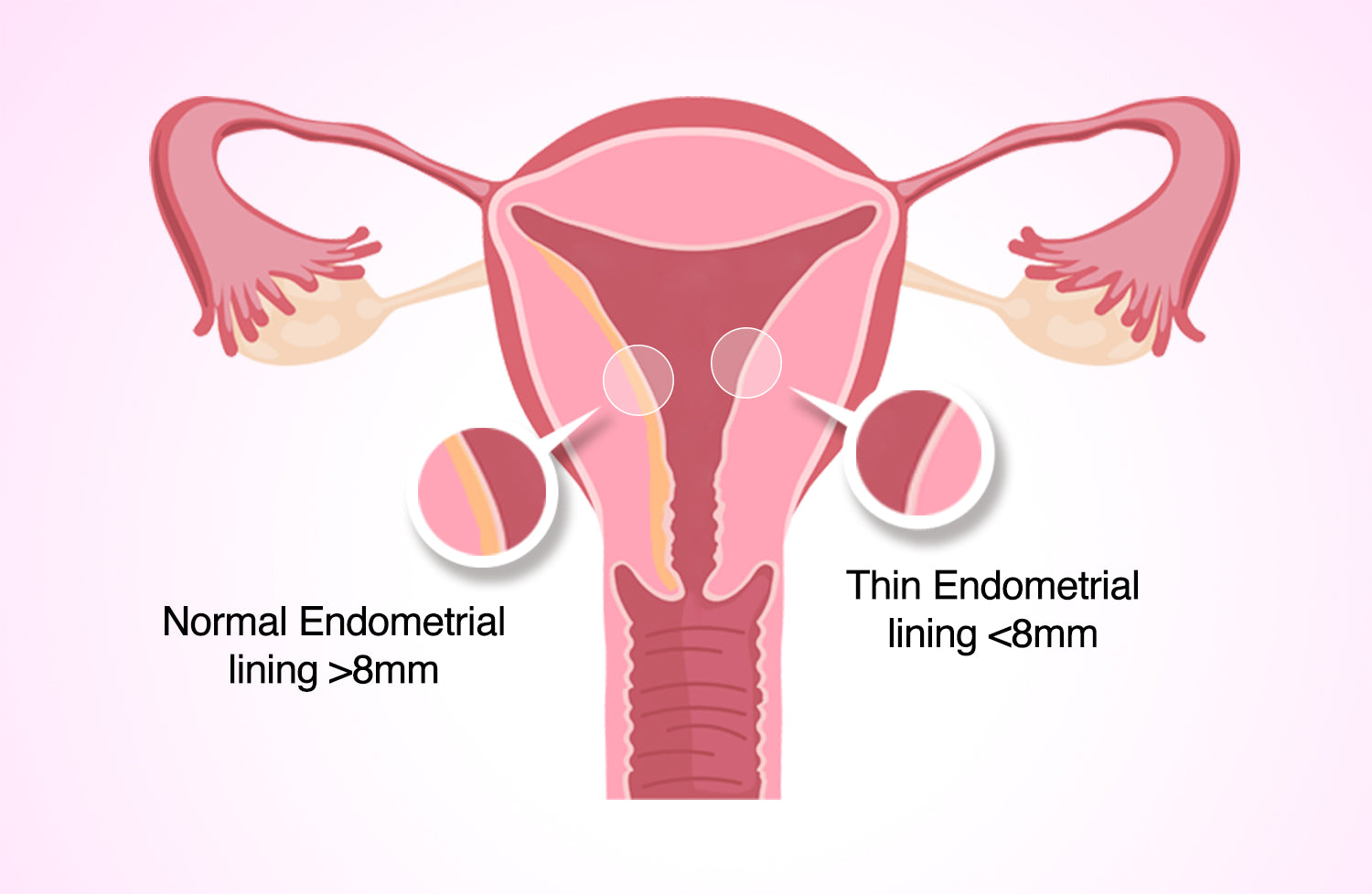 How Hormonal IUDs Affect Your Endometrial Lining Premom