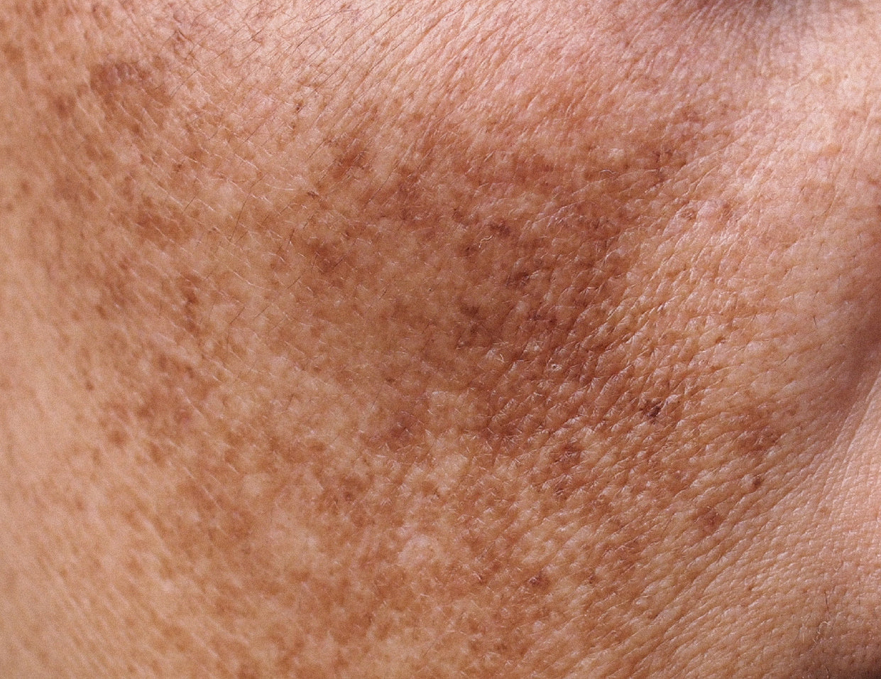Melasma Symptoms, Causes & Treatment Options Prequel