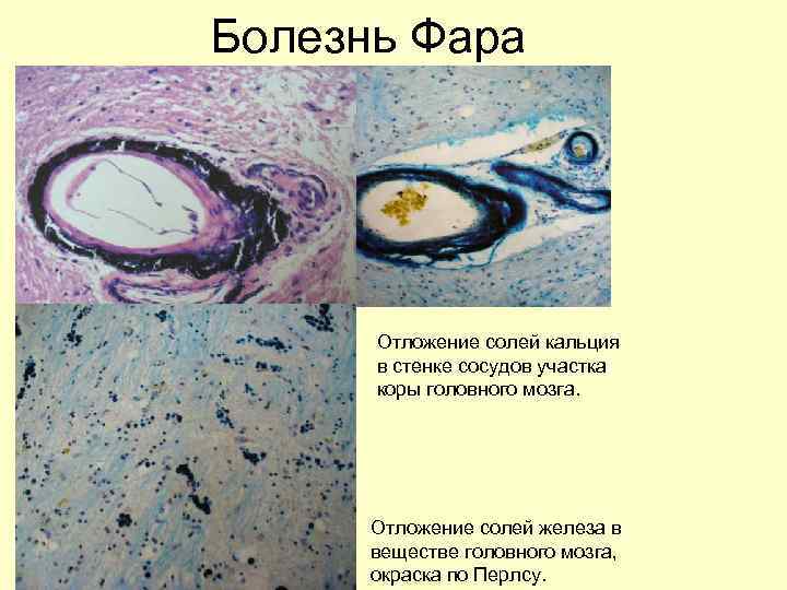 Внутренняя капсула гиппокамп Парагиппокамп