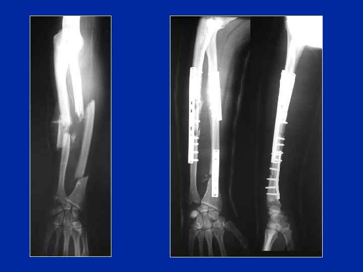 Fractures de l avantbras La pronosupination Pronation intermédiaire