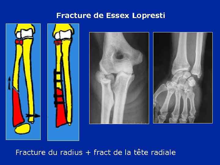Fractures de l avantbras La pronosupination Pronation intermédiaire