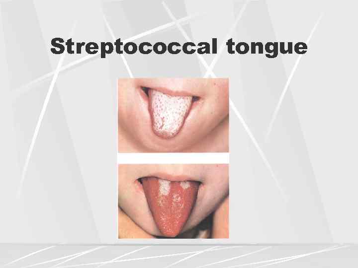 White Coating On Tongue Differential Diagnosis at Melissa Burt blog