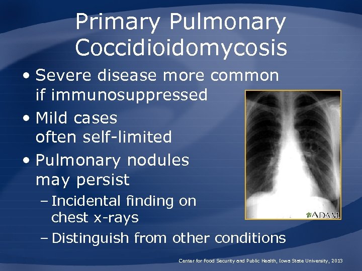 Coccidioidomycosis Valley Fever San Joaquin Valley Fever Desert
