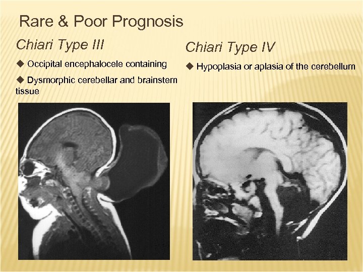 THE CHIARI MALFORMATIONS AND SYRINGOMYELIA DEFINITIONS Bermans J