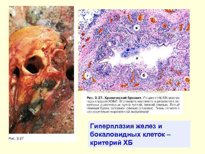 ХРОНИЧЕСКИЕ НЕСПЕЦИФИЧЕСКИЕ ЗАБОЛЕВАНИЯ ЛЕГКИХ ЛЕКЦИЯ Проф Л В