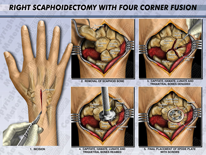 Scaphoidectomy Medical Legal Illustration