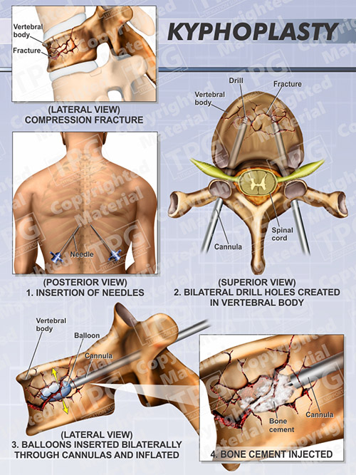 Kyphoplasty Order