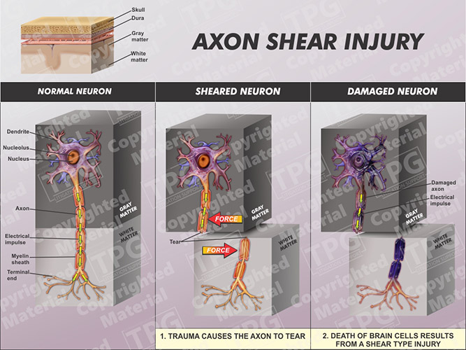 Axon Shear Injury Order