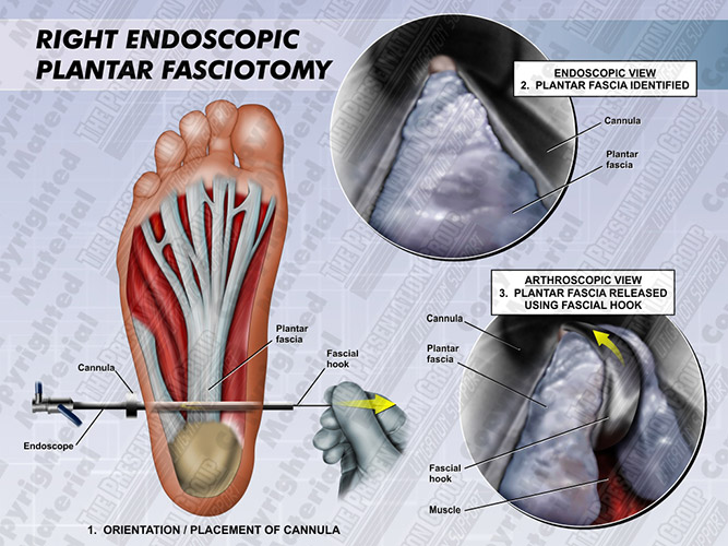 Plantar Fasciotomy Medical Legal Illustration