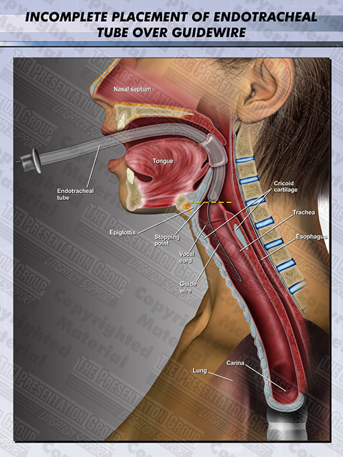 Placement of Endotracheal Tube Medical Legal Illustration