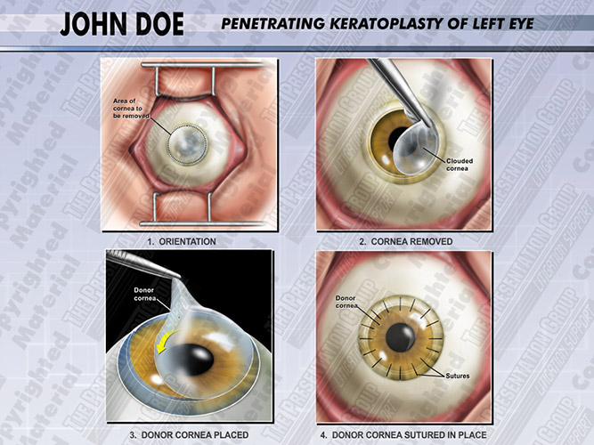 Keratoplasty Medical Legal Illustration