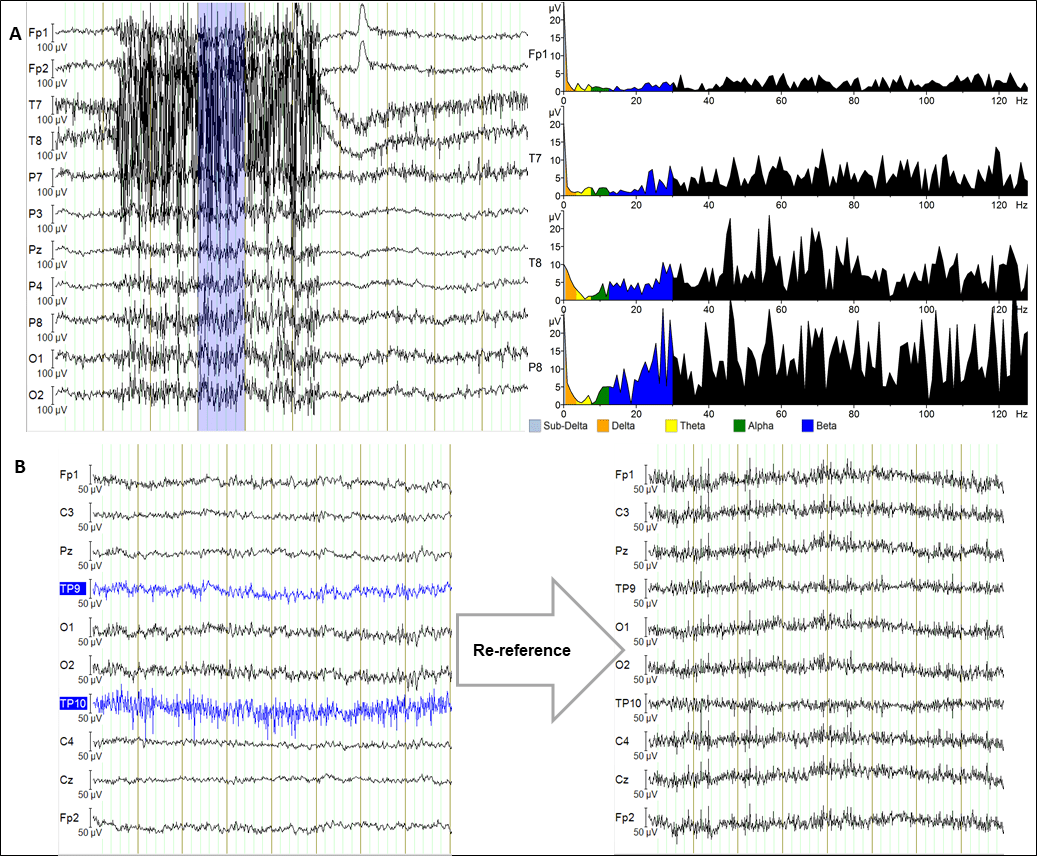 Getting to know EEG artifacts and how to handle them in BrainVision Analyzer