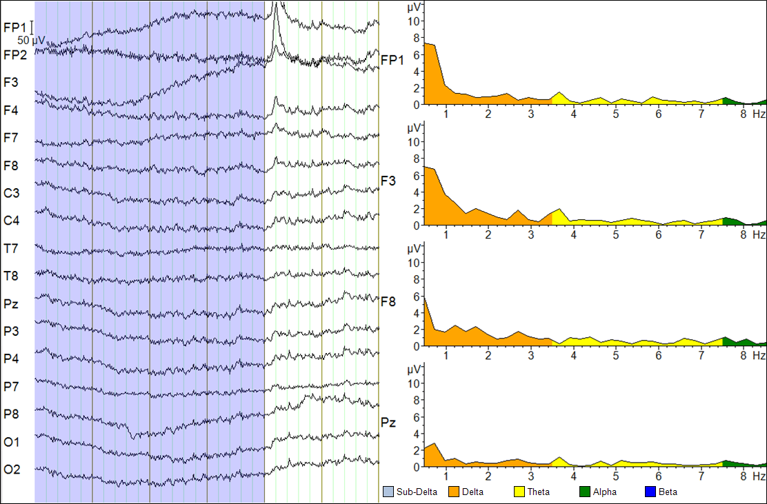 Getting to know EEG artifacts and how to handle them in BrainVision Analyzer