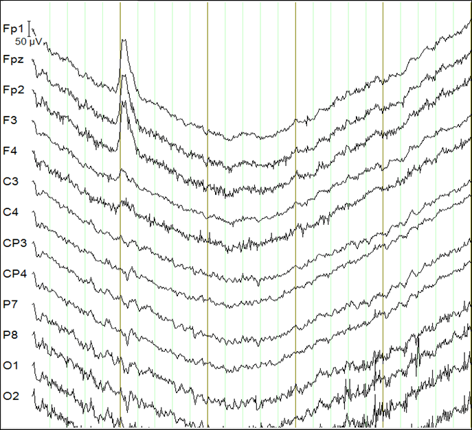 Getting to know EEG artifacts and how to handle them in BrainVision