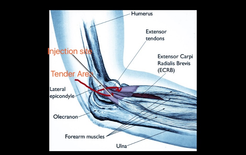 Prestige Pain Centers Tendon Steroid Injections