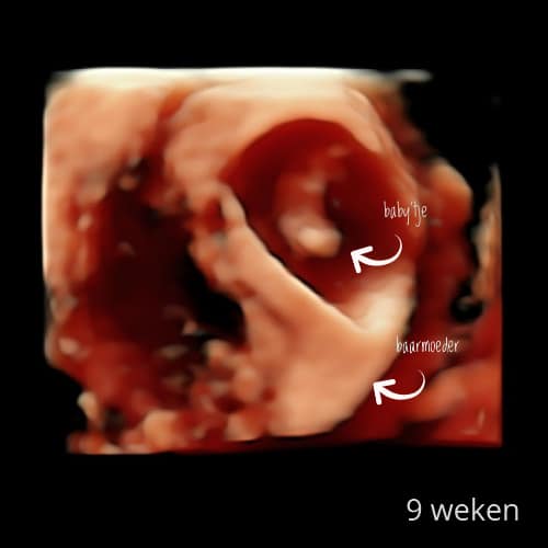 9 WEKEN 3D / 4D PRETECHO Pretecho&zo