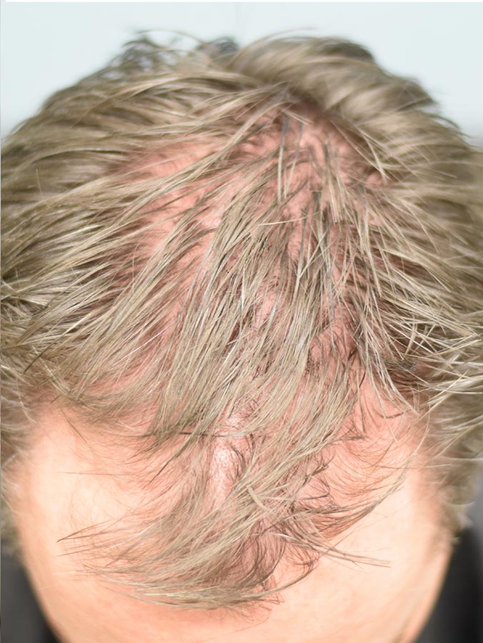 Calgary Hair Loss Hair Loss Treatment Calgary Preventous