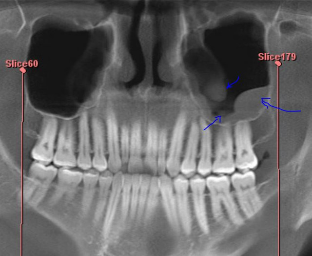 Mucosal retention cyst from wisdom tooth removal? r/Dentistry