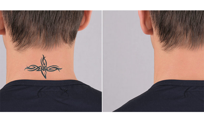 Perché Rimuovere Un Tatuaggio? I 5 Motivi Più Comuni - Prima Bergamo 390_x_650_jpg
