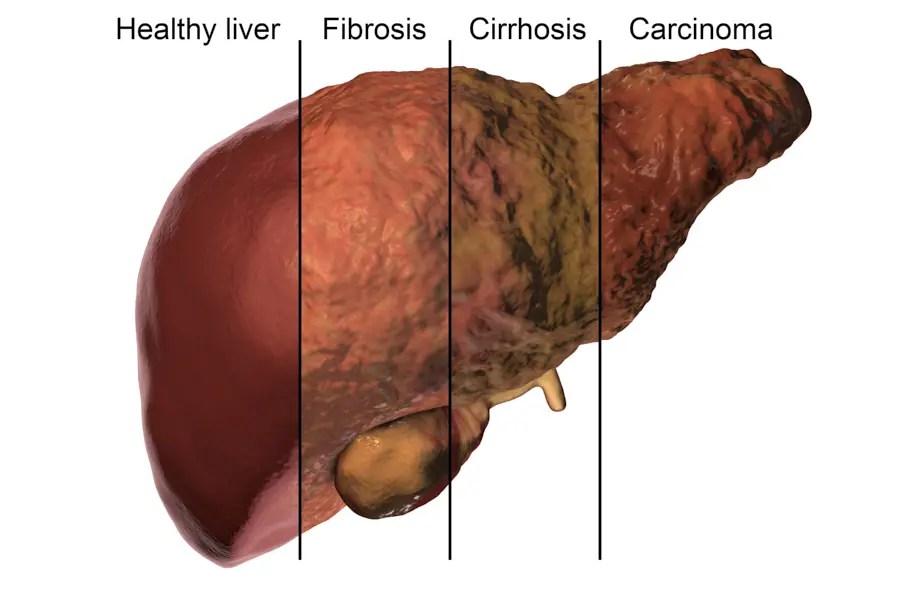 Revitalize Your Liver Top Cleansing Strategies with Herbs and