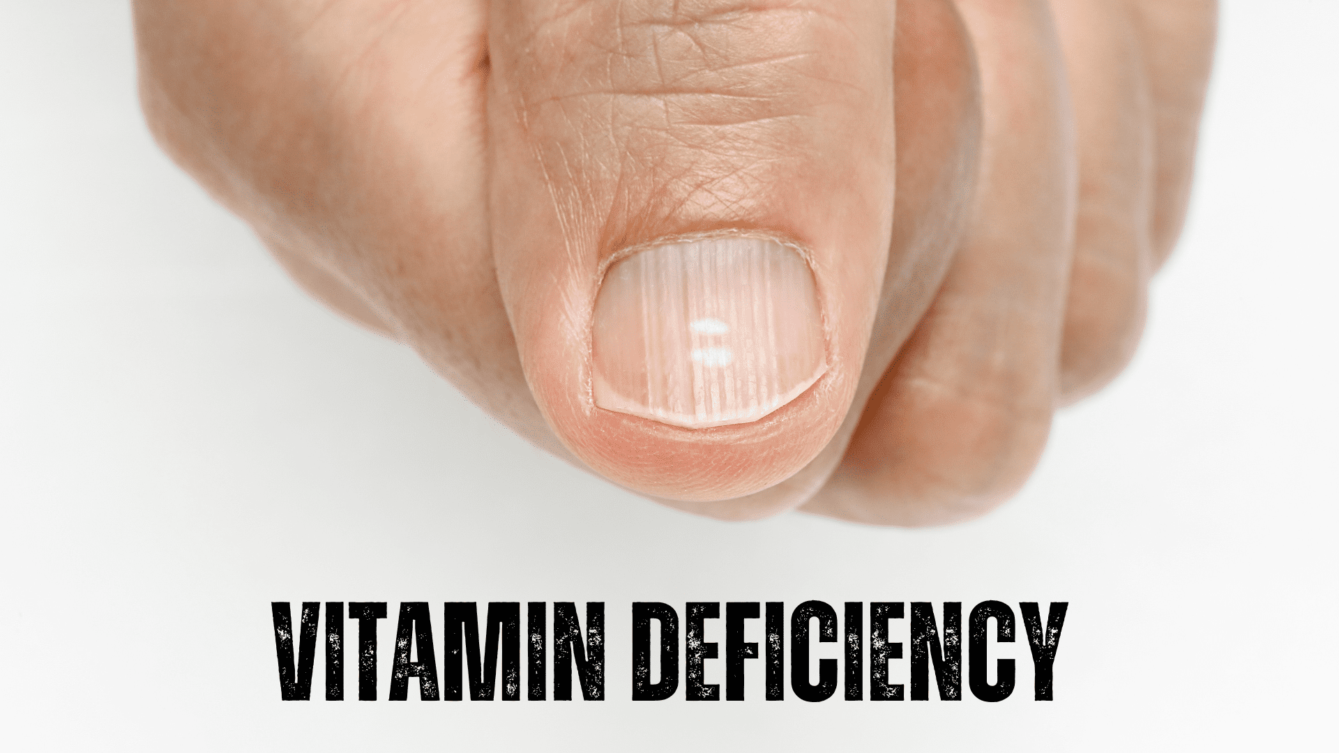 Which Vitamin Deficiency Is Most Common? Prime Fit Hub