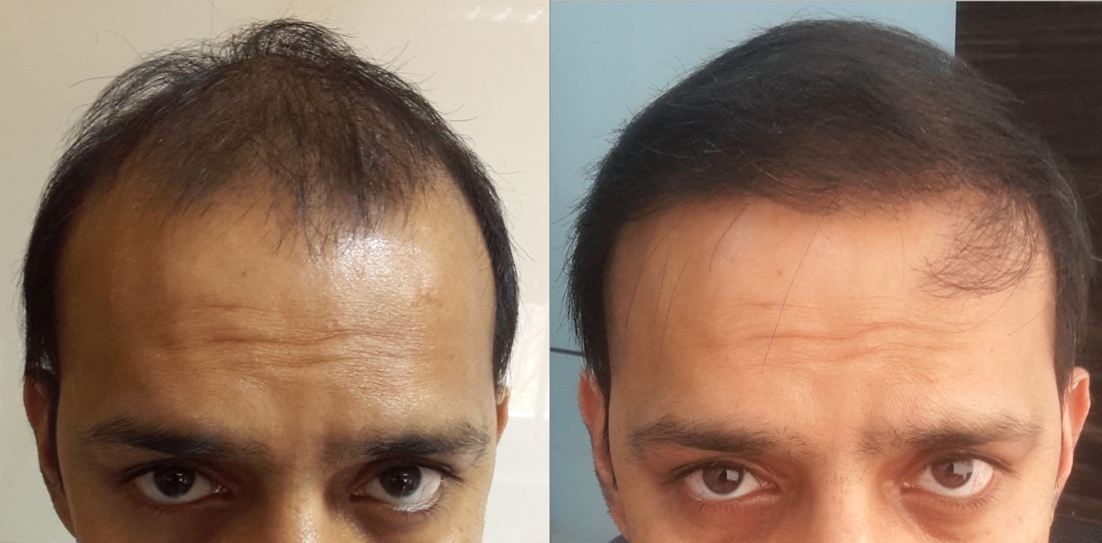 Cost of Hair Transplant in Mumbai, India Prime Hair Studio