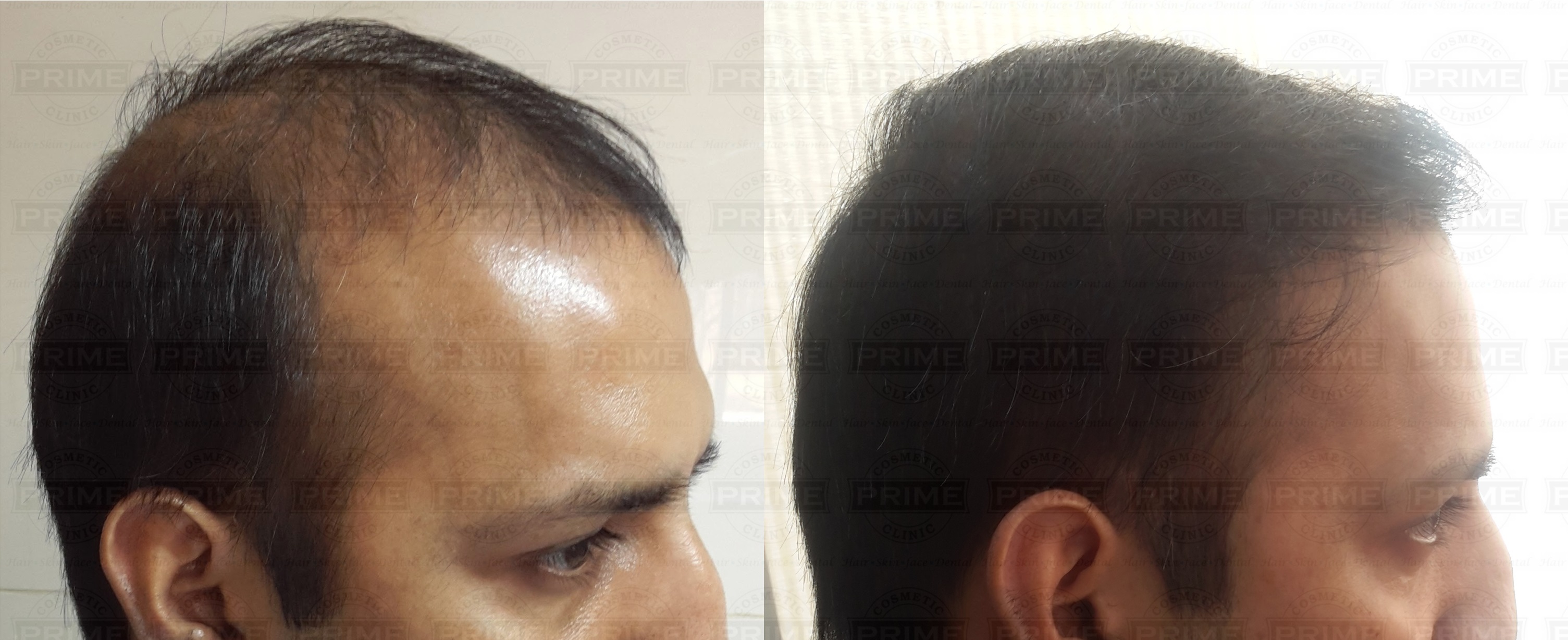Biofibre Hair Implant Before and After Prime Hair Studio & Cosmetic