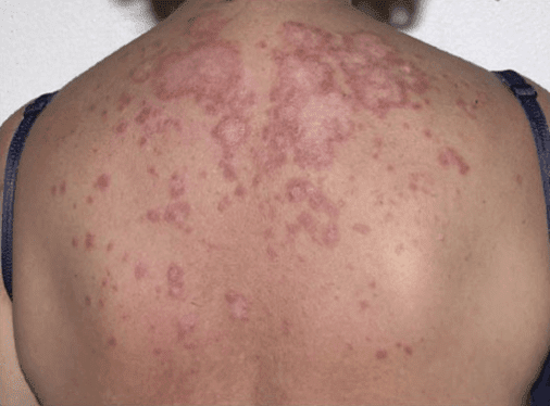What Causes An Autoimmune Rash? 10 Possible Conditions - Primehealth Denver