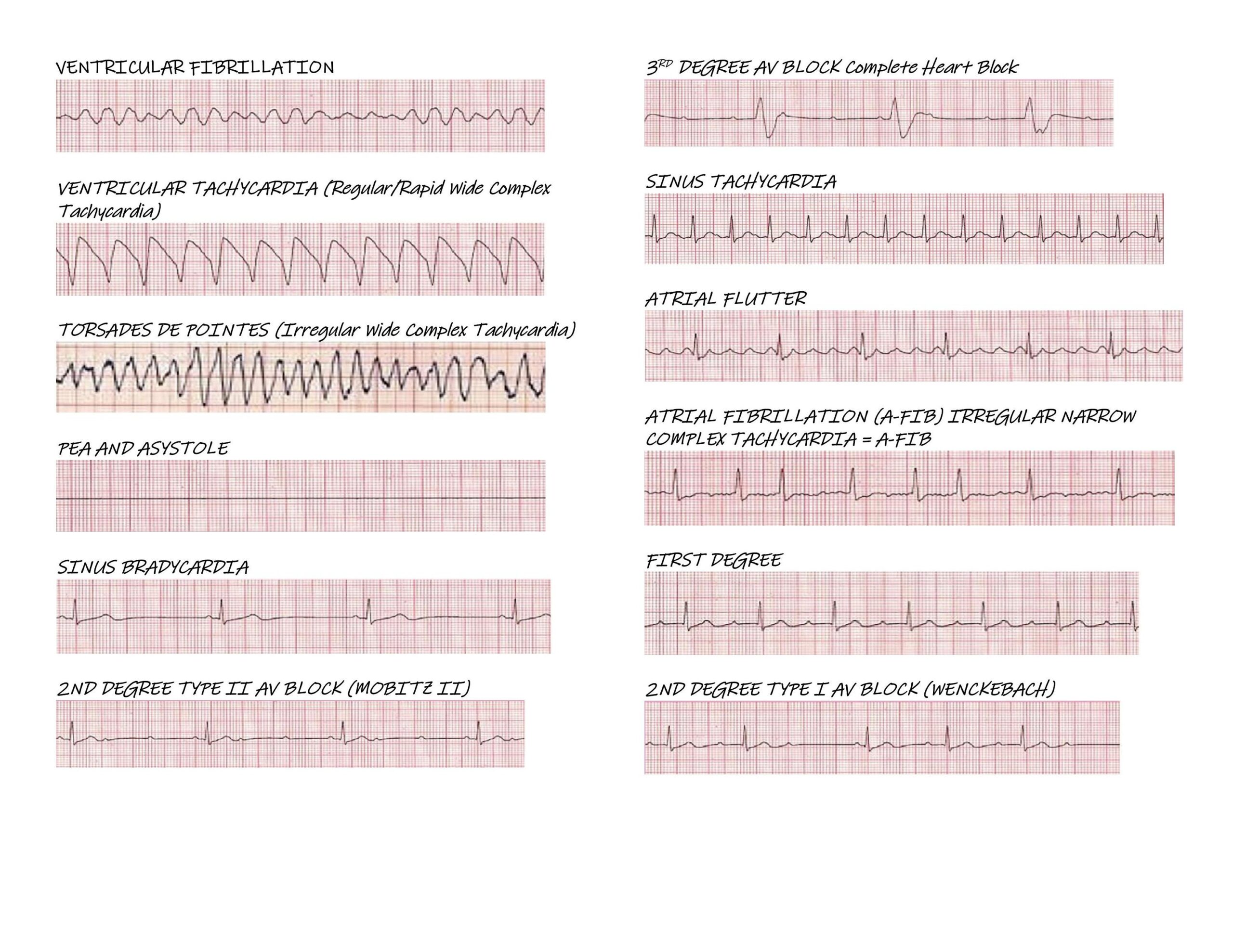 Ekg Practice Strips Printable UK Printable Hub