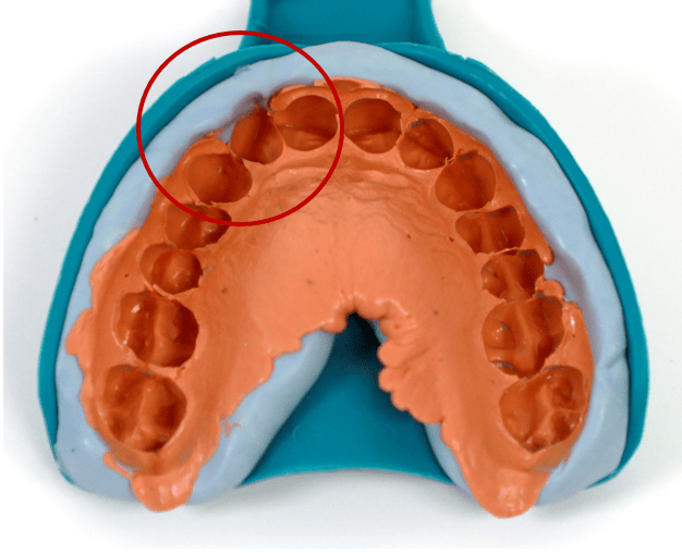 DENTAL IMPRESSION PRISTINE CLEAR ALIGNERS