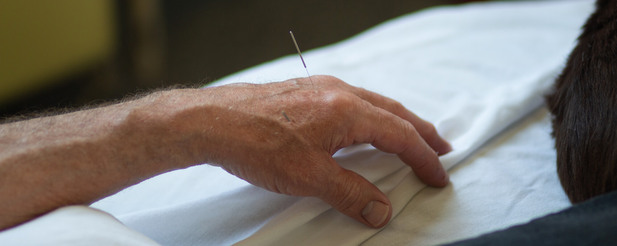 What Is Acupuncture? » Professional Acupuncture & Physical Therapy Acupuncture in Duluth, MN
