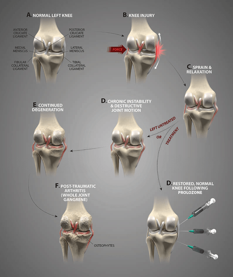 Knee Pain Treatment London, Knee Instability Physiotherapy/Rehabilitation
