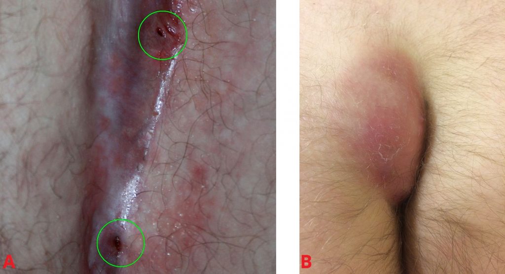 Pilonidal Sinus Treatment In Pune 100 Painless Procedure