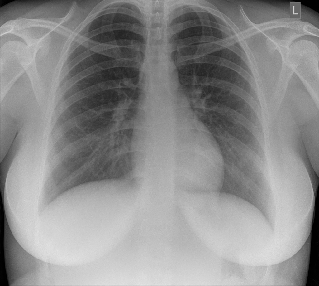 Normal Chest X Ray Images