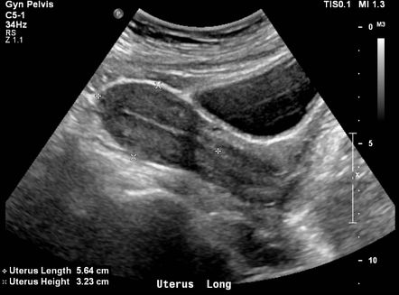 May 29, 2020 · a pelvic ultrasound is a noninvasive diagnostic exam that produces images that are used to assess organs and structures within the female pelvis. Pelvic Ultrasound Radiology Reference Article Radiopaedia Org